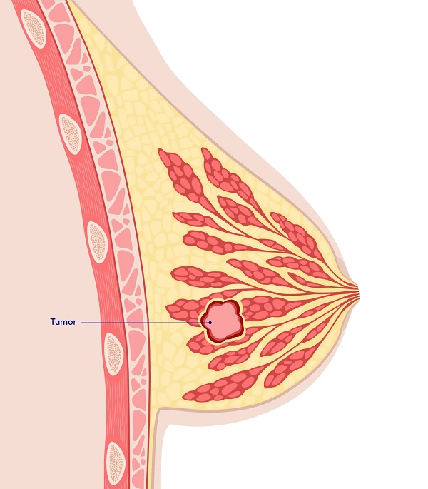Symptoms of Breast Cancer